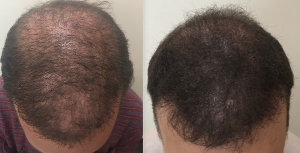 SMP After Hair Transplant