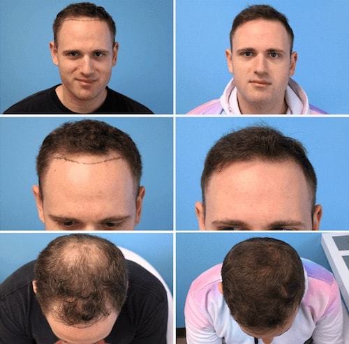 After Hair Transplant