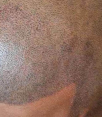 Do I need Scalp Micropigmentation