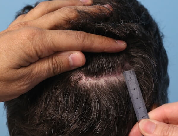 Scar after strip hair transplant