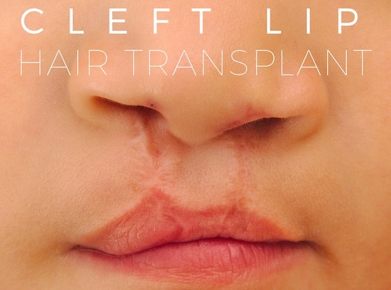 Hair Transplant for Cleft Lip