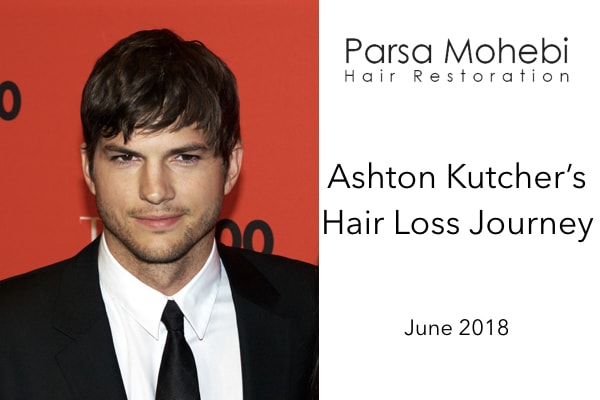 Hair loss journey for Ashton Kutcher