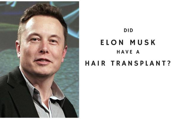 Did Elon Musk have a hair transplant