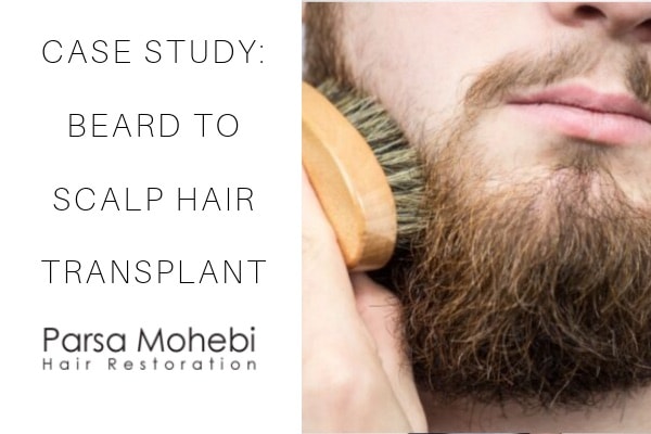 beard to scalp fue transplant case study