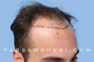 this is an image of hair transplant patient in Portola