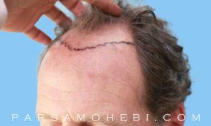 this is an image of hair transplant patient in Russian Hill