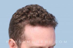this is an image of a hair transplant patient in Sunset District