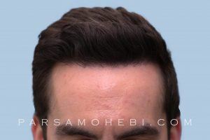 this is an image of hair transplant patient in West Hollywood