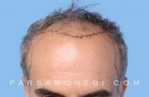 this is an image of hair transplant patient in Albany