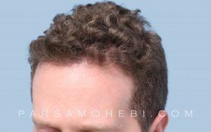 this is an image of hair transplant patient in Fairfield