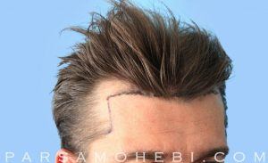 this is an image of hair transplant patient in San Jose