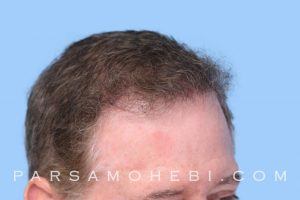 this is an image of hair transplant patient in San Leandro