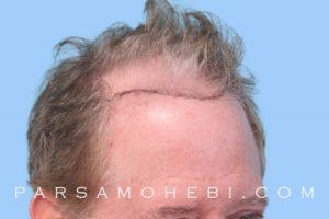 this is an image of hair transplant patient in San Leandro