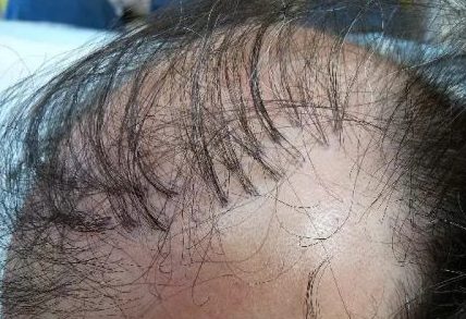 Why hair transplant plugs aren't used