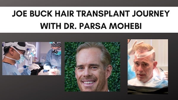 Joe Buck hair transplant with Dr. Parsa Mohebi