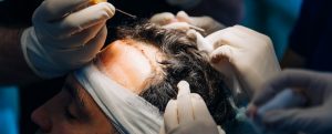 Hair transplant for transgender patients helps affirm patient gender